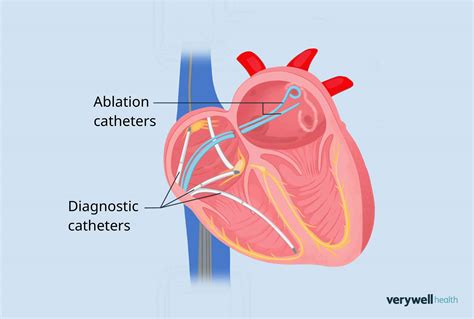 Heart Ablation Procedure