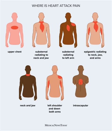 Heart Attack Pain Location And More Heart Attack Pain Location And More