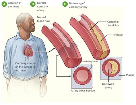 Heart Disease Coronary Heart Disease