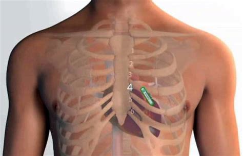 Heart Monitor Implant