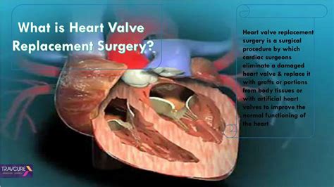 Heart Valve Replacement Surgery