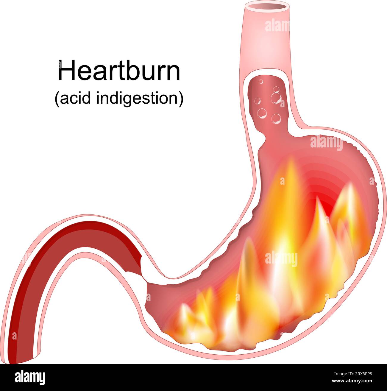 Heartburn Causes: Diagnostic Guide Inside