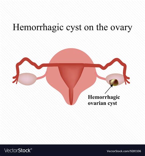 Hemorrhagic Cyst Ovary Navigating The Challenges With Grace A