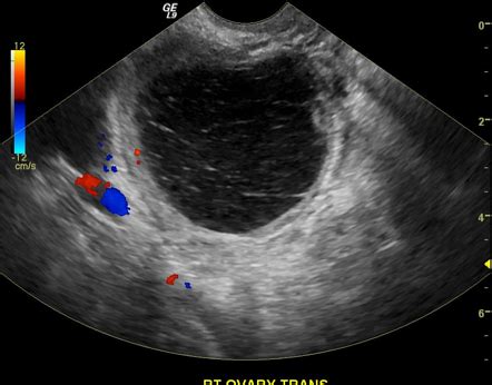 Hemorrhagic Ovarian Cyst Radiology Reference Article Radiopaedia Org