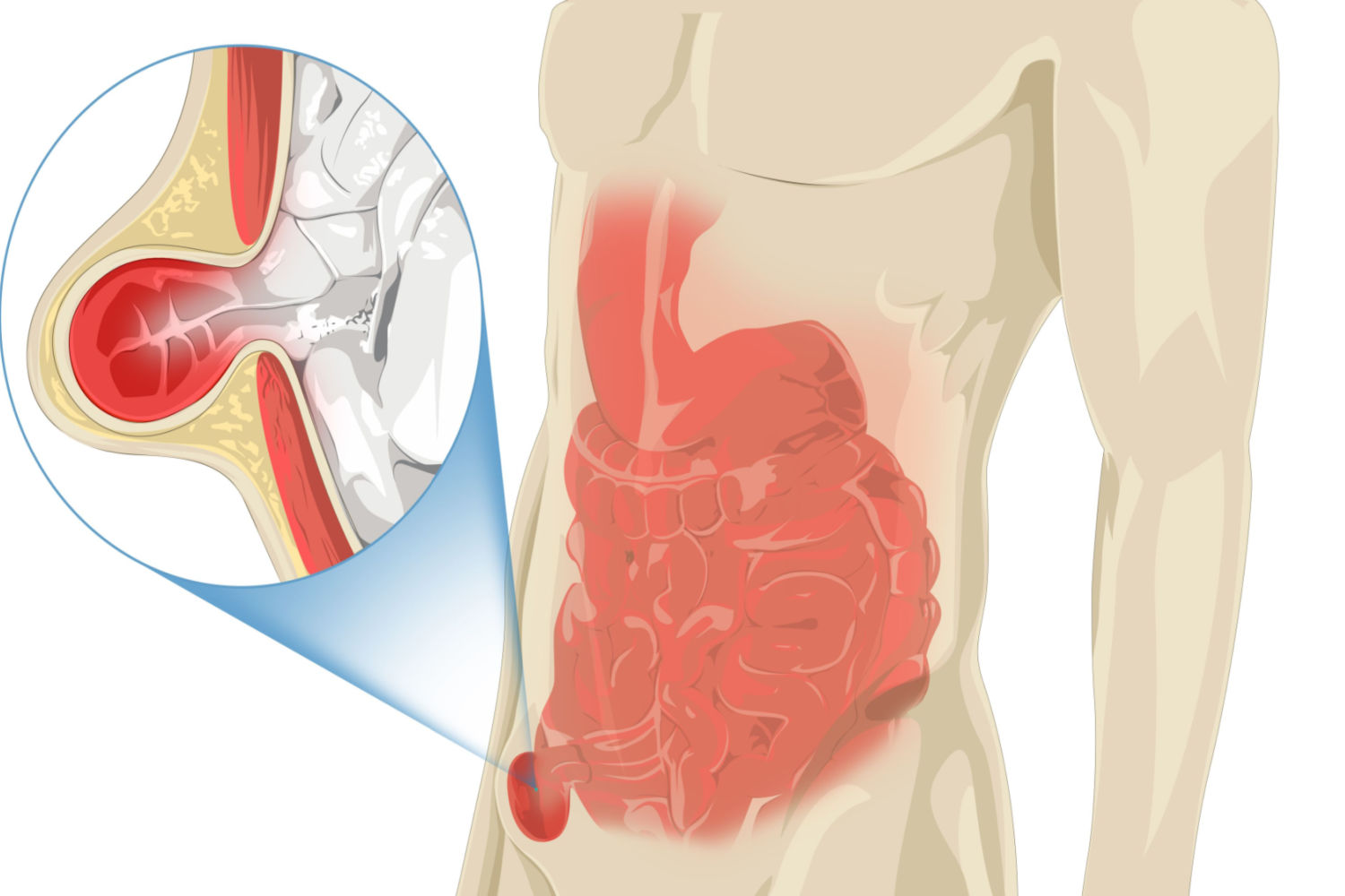 Hernia Navel Adult