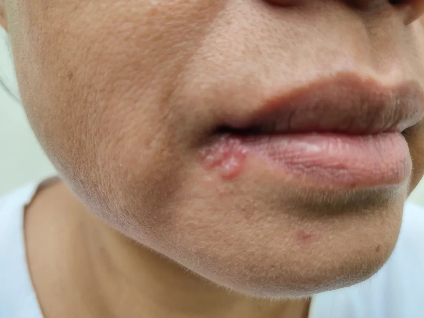 Herpes Simplex 1 Explained: Causes & Symptoms