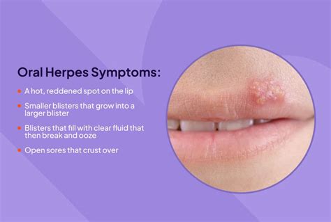 Herpes Virus Finger Guide: Symptoms Uncovered