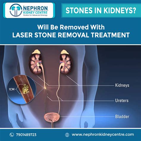 How Are Kidney Stones Removed? Easy Recovery
