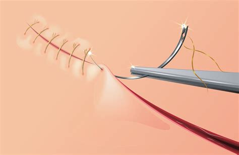 How Do Dissolvable Stitches Work? A Faster Recovery Guide