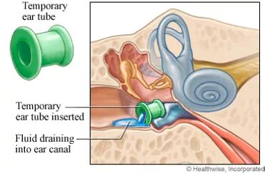 How Do Tubes In Ears Help? Solve Hearing Issues