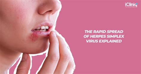 How Does Herpes Simplex Virus Spread So Quickly How Does Herpes Simplex Virus Spread So Quickly