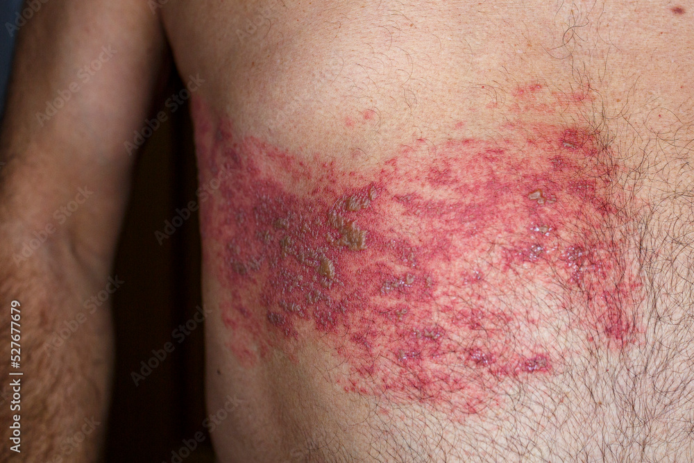 How Is Shingles Inside Eye Treated? Find Relief