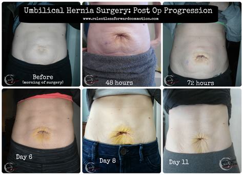 How Long Is Belly Button Hernia Surgery Recovery?