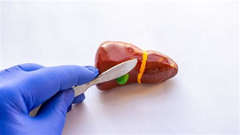 How Long To Recover From Gallstone Surgery? Timeline Guide