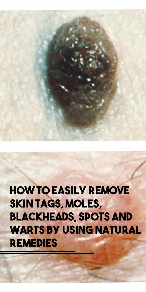 How To Easily Remove Skin Tags Moles Blackheads Spots And Warts With