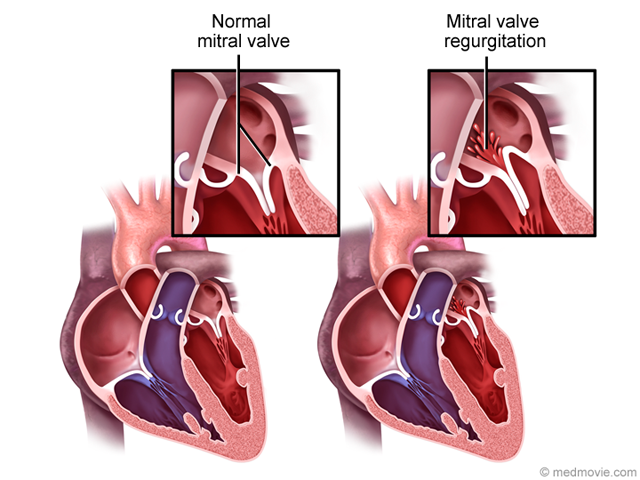 How To Fix Mitral Valve? Minimally Invasive Options