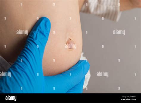 How To Fix Umbilical Hernia Braincycle1 How To Fix Umbilical Hernia Braincycle1
