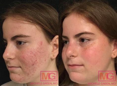How To Get Accutane