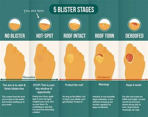 How To Heal Foot Bisters? Expert Treatment Tips