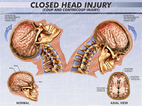 How To Recover From Closed Head Injury? Proven Tips