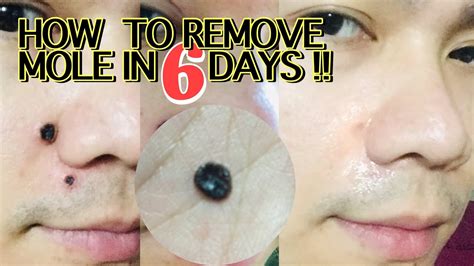 How To Remove A Mole
