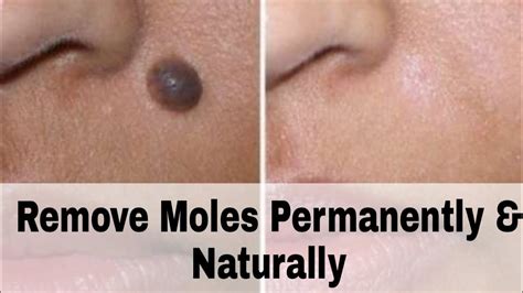 How To Remove Moles
