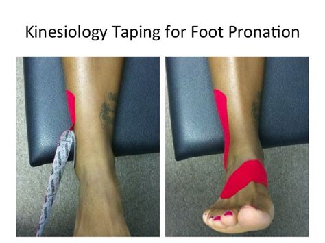 How To Stop Pronation Of The Foot? Relief Tips Inside