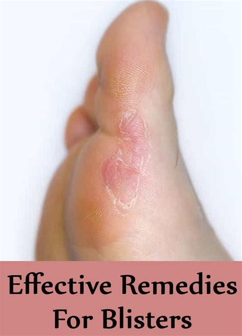 How To Treat A Big Blister On Your Foot Effective Remedies And Tips How To Treat A Big Blister On Your Foot Effective Remedies And Tips