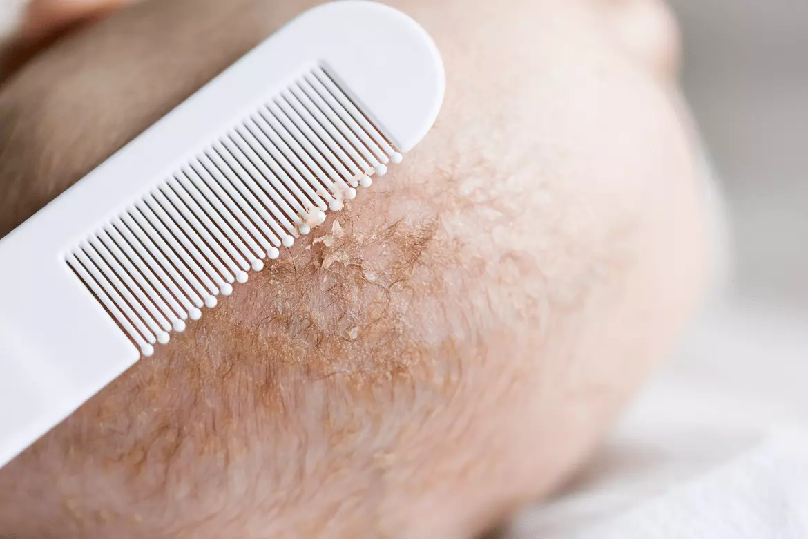 How To Treat Cradle Cap
