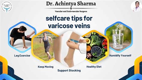 How To Treat Varicose Veins? Selfcare Tips
