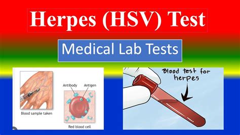 Hsv Blood Test Results Decoded