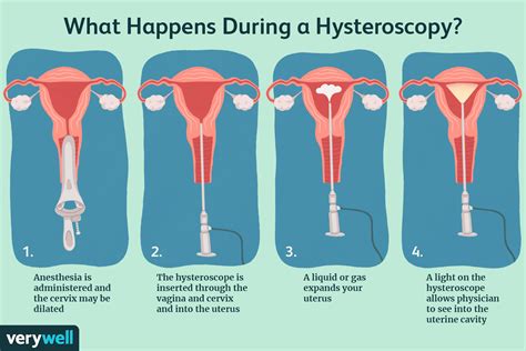 Hysteroscopy Dilation And Curettage