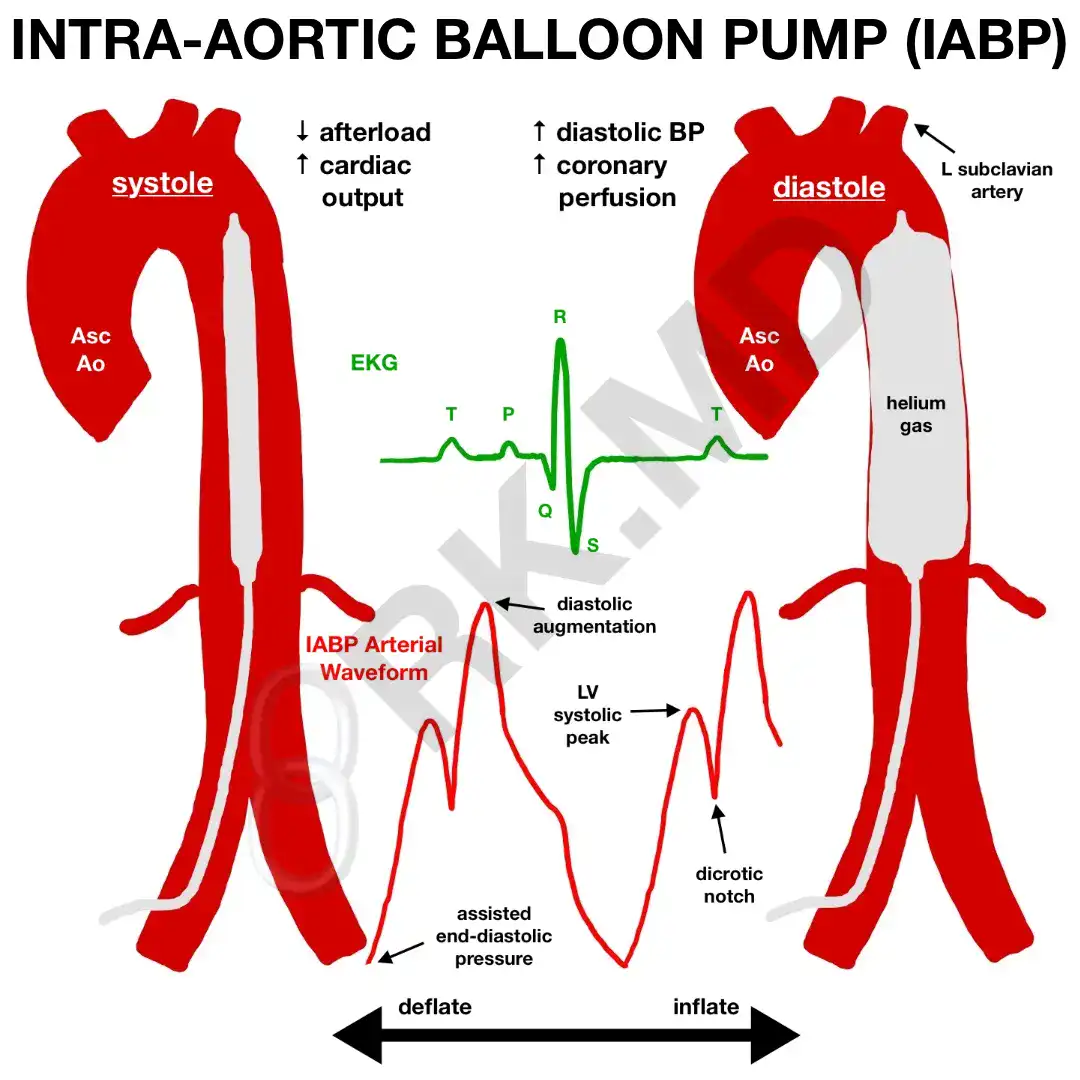 Iabp Therapy: Comprehensive Support Solutions