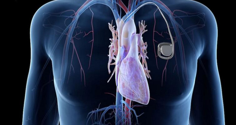 Implantable Loop Recorder Test Cardiology Tests Sa Heart Implantable Loop Recorder Test Cardiology Tests Sa Heart