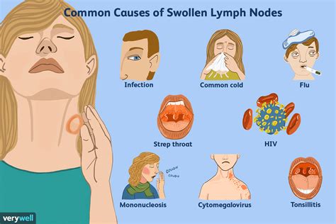 Infected Lymph Node