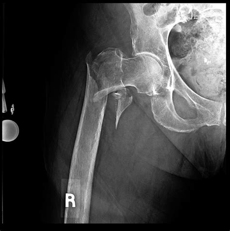 Intertrochanteric Hip Fracture