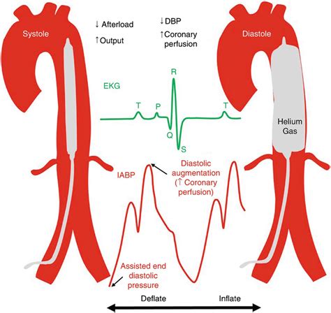 Intra Aortic Balloon Pump