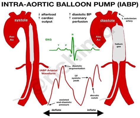 Intraaortic Balloon Pump Guide: Expert Insights