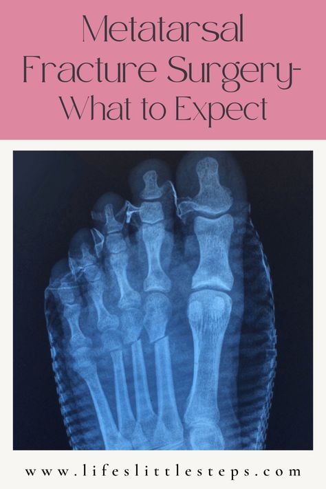 Jones Fracture Recovery Guide