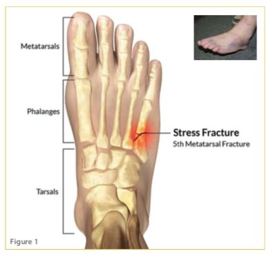 Jones Fracture Sports Clinic Nq Jones Fracture Sports Clinic Nq