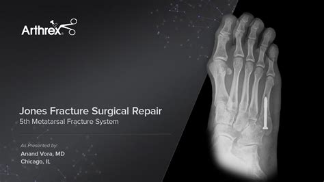 Jones Fracture Treatment