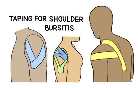 Kt Tape For Shoulder Bursitis Pain Injury Health Blog Kt Tape For Shoulder Bursitis Pain Injury Health Blog