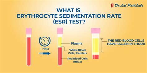 Lab Test Esr Guide: Understand Your Inflammation Levels