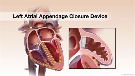 Left Atrial Appendage Closure For Stroke Risk Reduction In Nonvalvular Left Atrial Appendage Closure For Stroke Risk Reduction In Nonvalvular