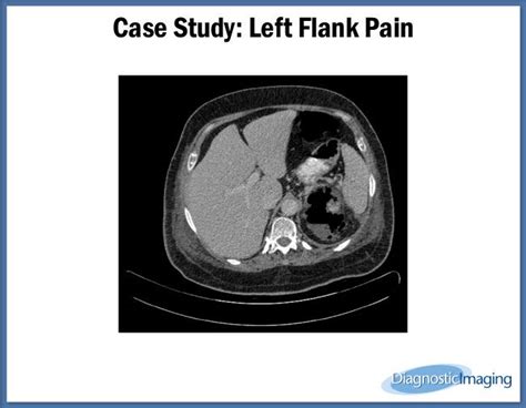 Left Flank Pain Diagnostic Imaging