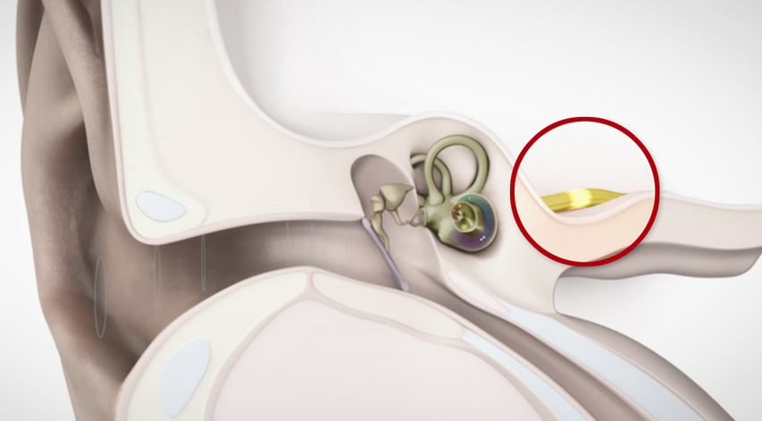 Lippy Surgery Center Warren Oh Implants For Hearing Loss And Deafness Lippy Surgery Center Warren Oh Implants For Hearing Loss And Deafness