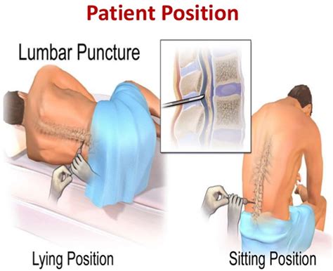 Lumbar Puncture Procedure Position Lumbar Puncture Side Effects Lumbar Puncture Procedure Position Lumbar Puncture Side Effects