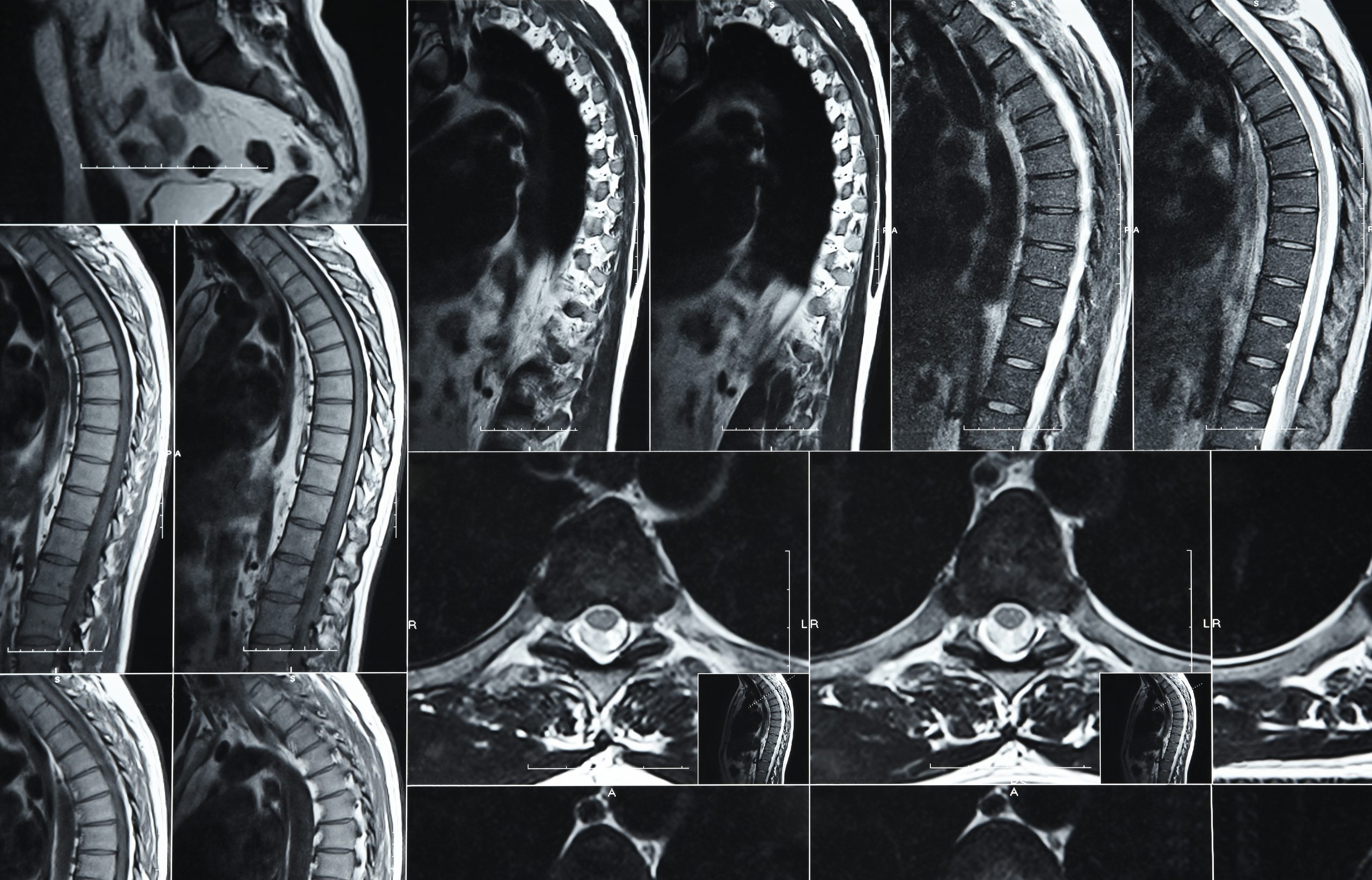 Lumbar Spine Mri: Comprehensive Scan Results