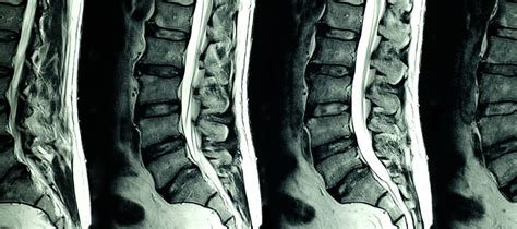 Lumbar Spine Mri Guide: Accurate Diagnosis