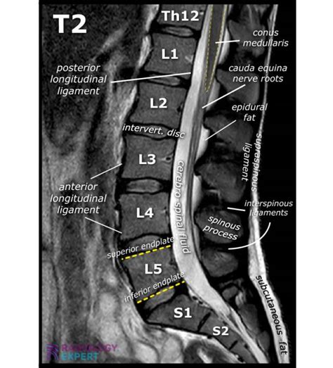 Lumbar Spine Mri